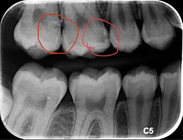 19. Dental X-rays Are Safer Than You Think