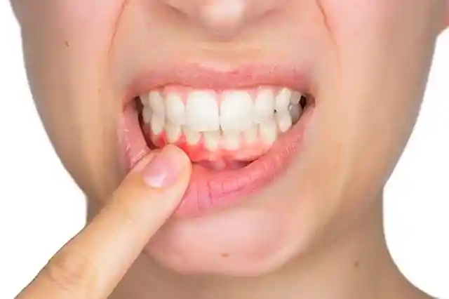 4. Bleeding Gums Aren't Normal