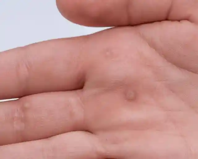 Remove warts immediately