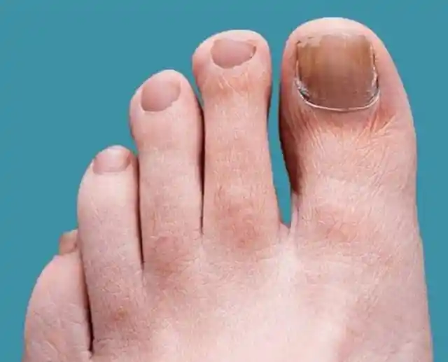 Treat toenail fungus