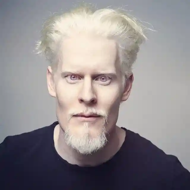 Albinism of Stephen Thompson