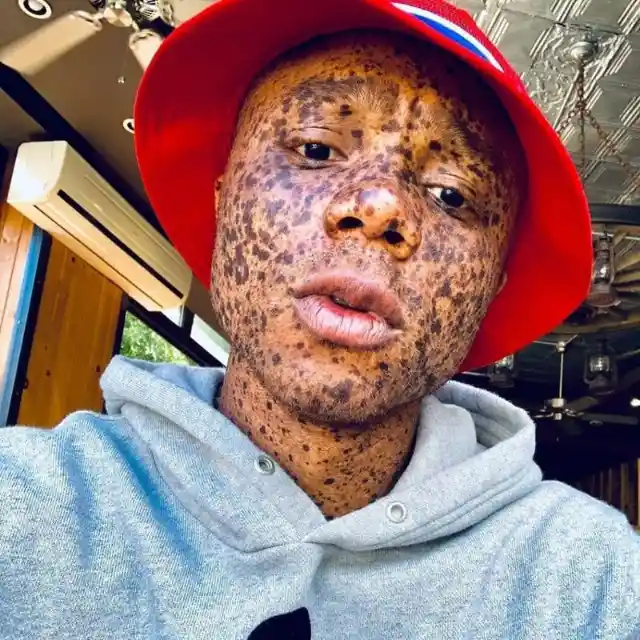 Freckles of Ralph Souffrant