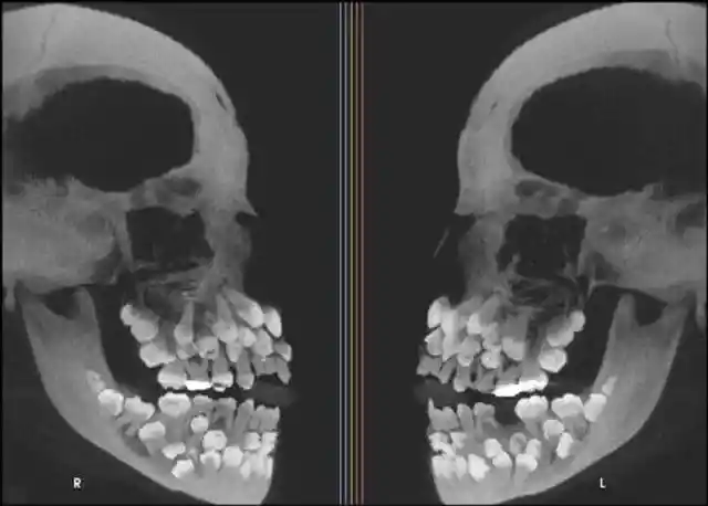 Vampires Or Just Multiple Hyperdontia?