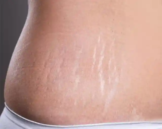 Get rid of stretch marks