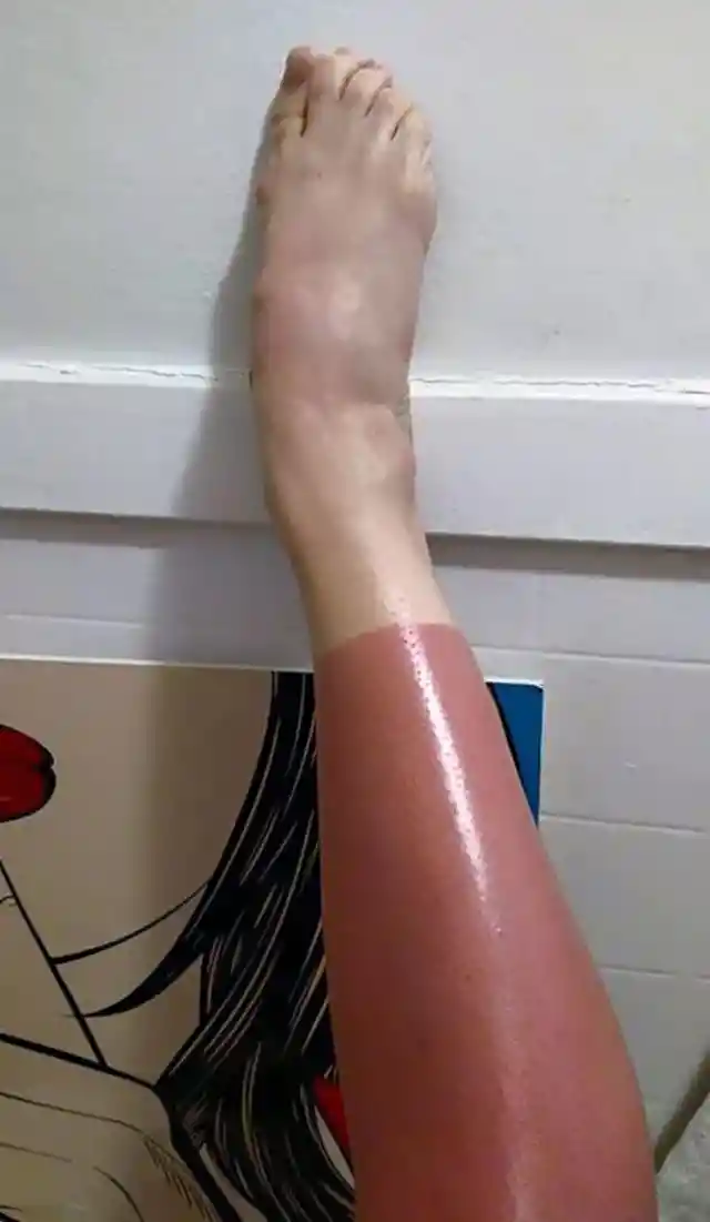 Perfect looking sunburn