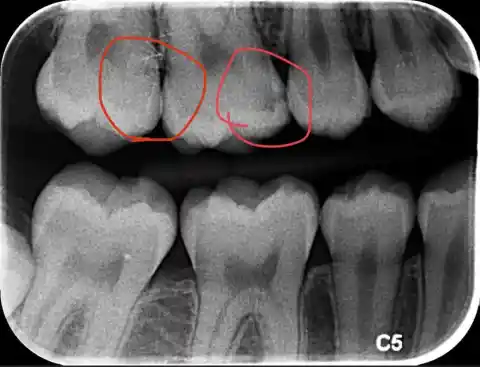 19. Dental X-rays Are Safer Than You Think