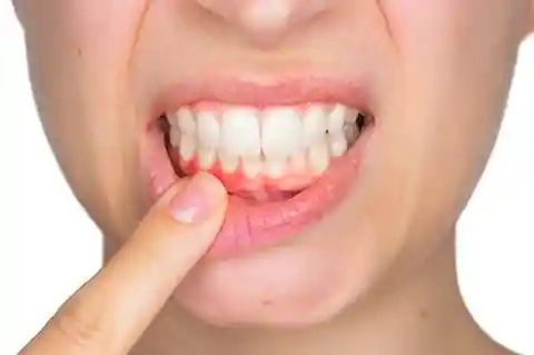 4. Bleeding Gums Aren't Normal
