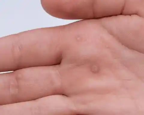 Remove warts immediately