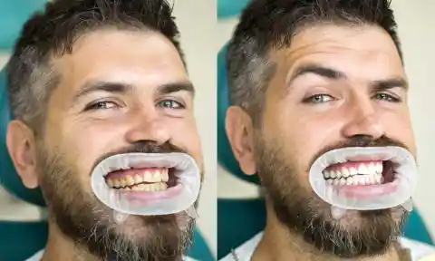 10. Teeth Whitening Can Weaken Enamel