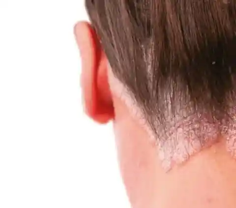 Add moisture to dry scalp