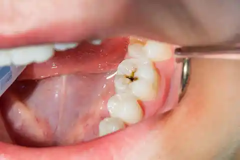 13. Cavities Can Develop Under Dental Work