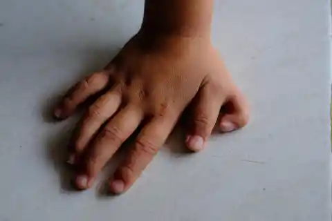 Extra Finger / Toe