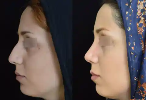 7. Nose Job Capital of the World